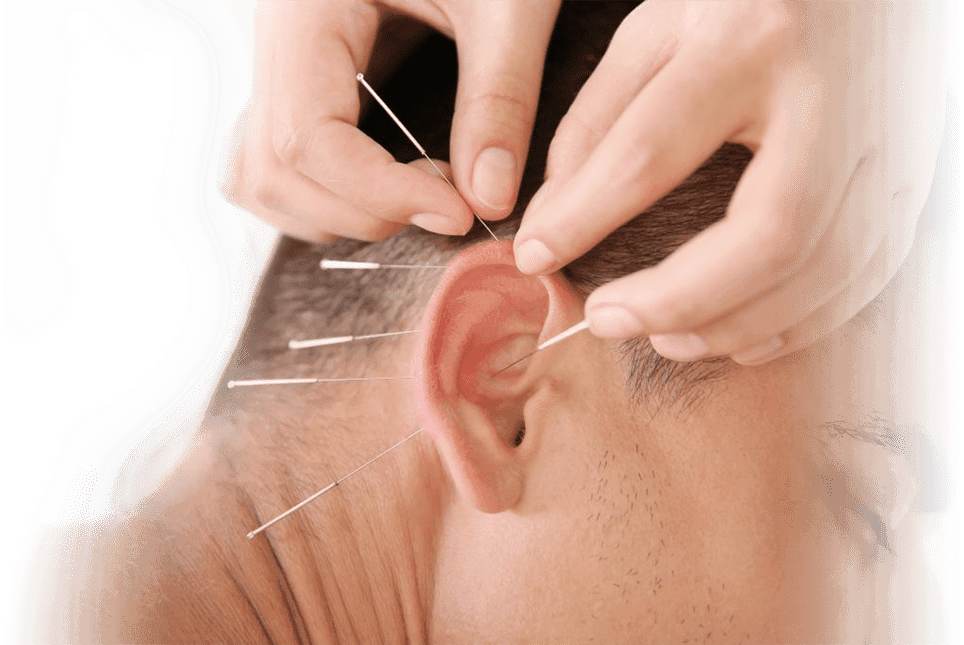 Auriculotherapy
